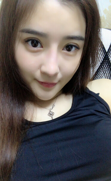 張家港唯恩整形醫(yī)院陳天杰醫(yī)生切開雙眼皮案例效果對比圖