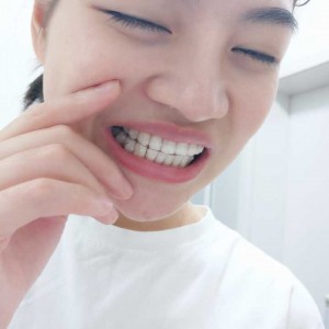 廈門拜博口腔醫(yī)院醫(yī)生張忠做牙齒隱形矯正怎么樣？附案例效果對比圖