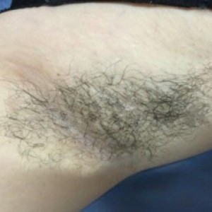廈門張銘整醫(yī)療整形醫(yī)生張小玲做激光脫腋毛怎么樣？附激光脫腋毛效果對比圖