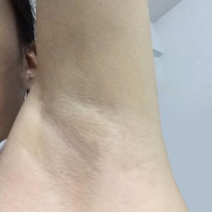 廈門張銘整醫(yī)療整形醫(yī)生張小玲做激光脫腋毛怎么樣？附激光脫腋毛效果對比圖
