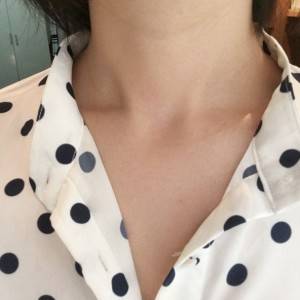 上海名媛醫(yī)療整形醫(yī)生閆嬌君做嗨體去頸紋效果怎么樣？附案例效果圖