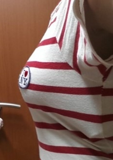 廣州基立嘉韓醫(yī)學(xué)整形醫(yī)院醫(yī)生劉朝忠做假體隆胸怎么樣？附案例效果對(duì)比圖