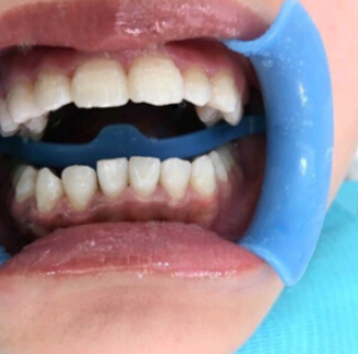 洛陽友好口腔醫(yī)院醫(yī)生楊愛芳做牙齒冷光美白怎么樣？附案例效果圖