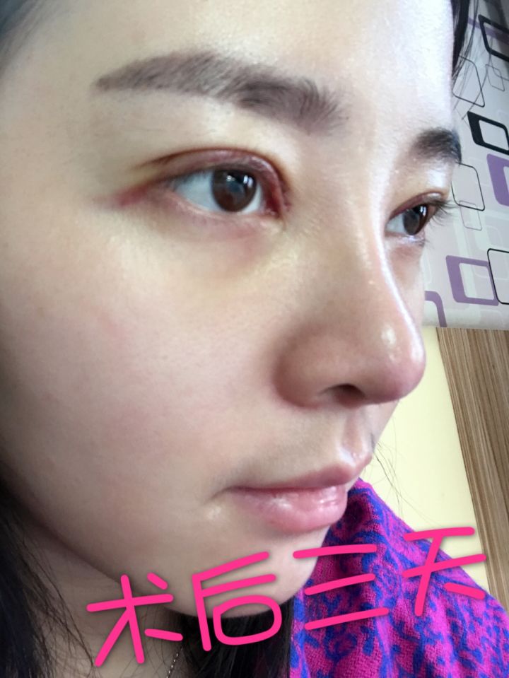 北京京韓整形醫(yī)生王義山做埋線雙眼皮怎么樣？附案例效果對(duì)比圖