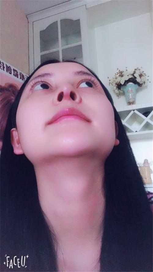 鄭州華領(lǐng)醫(yī)療美容醫(yī)院醫(yī)生張永濤做硅膠假體隆鼻怎么樣？附案例效果對比圖