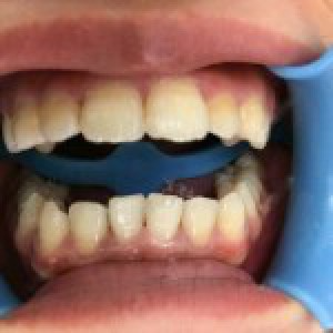 洛陽友好口腔醫(yī)院醫(yī)生楊愛芳做牙齒冷光美白怎么樣？附案例效果圖