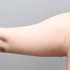 岳陽愛思特醫(yī)療美容醫(yī)院醫(yī)生王福生做手臂吸脂怎么樣？附案例效果圖