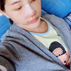 北京京民醫(yī)院整形外科醫(yī)生李鴻儒做硅膠隆鼻怎么樣？附案例效果圖
