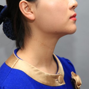 上海名媛醫(yī)療整形醫(yī)生閆嬌君做嗨體去頸紋效果怎么樣？附案例效果圖