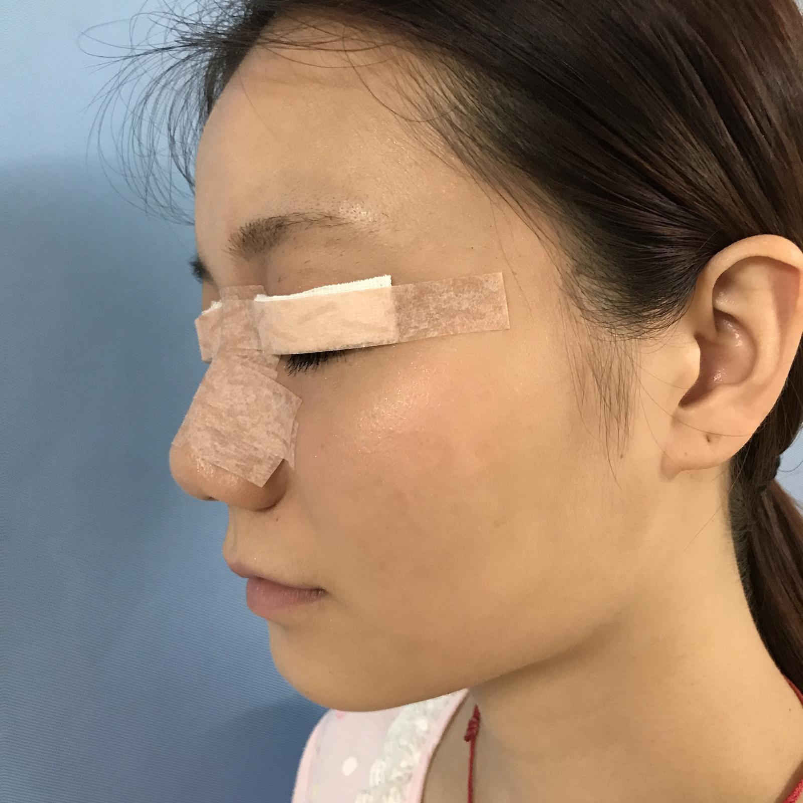 武漢華美整形醫(yī)院醫(yī)生王向陽做眼綜合整形怎么樣？附案例效果圖