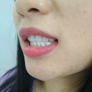 洛陽友好口腔醫(yī)院醫(yī)生李新然做牙貼面怎么樣？附案例效果圖