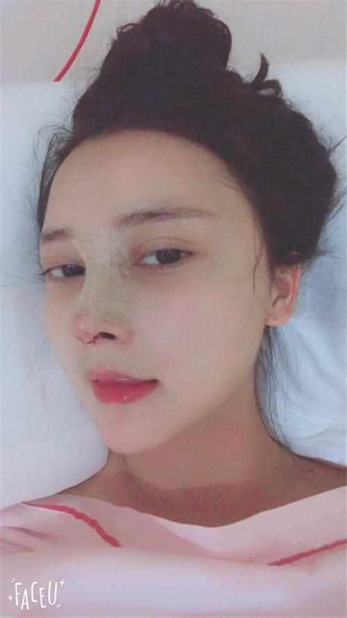 鄭州華領(lǐng)醫(yī)療美容醫(yī)院醫(yī)生張永濤做硅膠假體隆鼻怎么樣？附案例效果對比圖