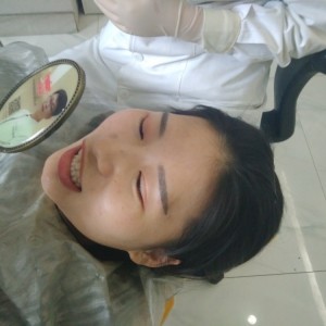 洛陽友好口腔醫(yī)院醫(yī)生李新然做牙貼面怎么樣？附案例效果圖