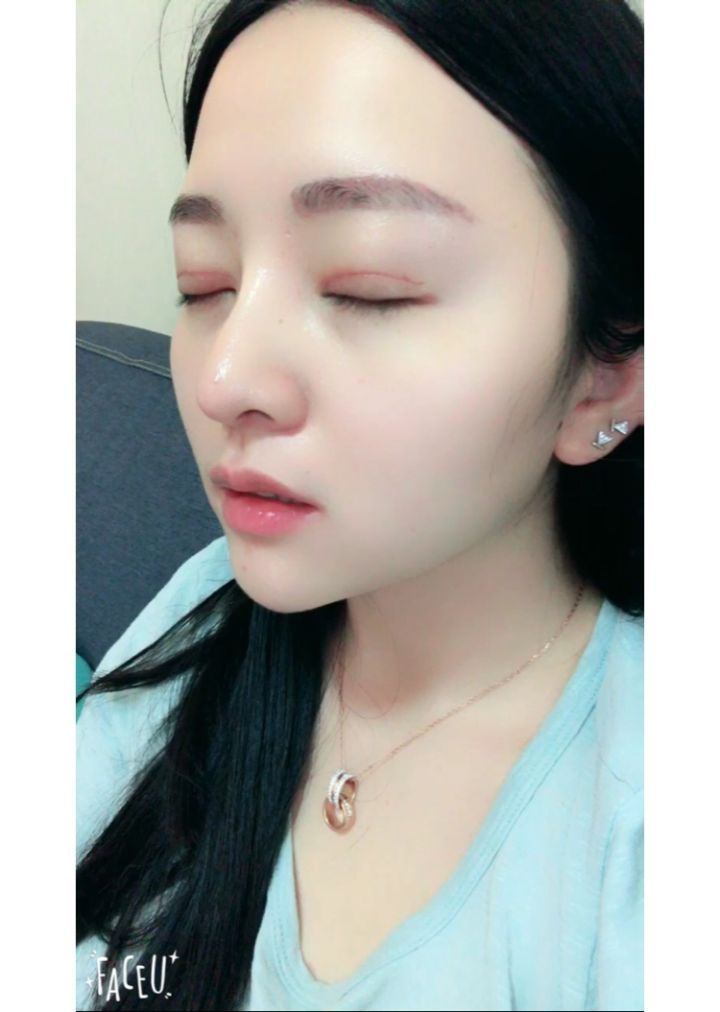 北京京韓整形醫(yī)生王義山做埋線雙眼皮怎么樣？附案例效果對(duì)比圖