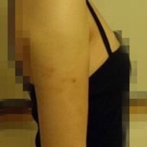 岳陽愛思特醫(yī)療美容醫(yī)院醫(yī)生王福生做手臂吸脂怎么樣？附案例效果圖