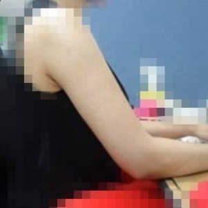 岳陽愛思特醫(yī)療美容醫(yī)院醫(yī)生王福生做手臂吸脂怎么樣？附案例效果圖