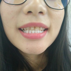 洛陽友好口腔醫(yī)院醫(yī)生李新然做牙貼面怎么樣？附案例效果圖