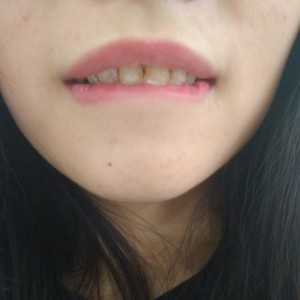 黔西南興義京州口腔醫(yī)院醫(yī)生徐勇做牙貼面怎么樣？附案例效果對(duì)比圖