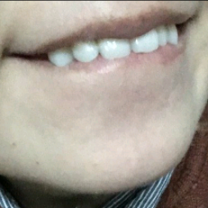 洛陽友好口腔醫(yī)院醫(yī)生楊愛芳做牙齒冷光美白怎么樣？附案例效果圖