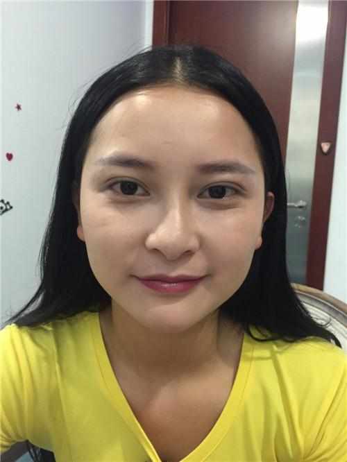 鄭州華領(lǐng)醫(yī)療美容醫(yī)院醫(yī)生張永濤做硅膠假體隆鼻怎么樣？附案例效果對比圖