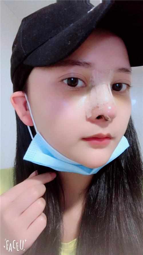 鄭州華領(lǐng)醫(yī)療美容醫(yī)院醫(yī)生張永濤做硅膠假體隆鼻怎么樣？附案例效果對比圖