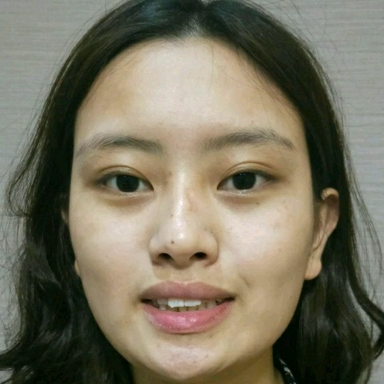 廣州愛(ài)來(lái)整形醫(yī)院醫(yī)生肖大衛(wèi)做激光點(diǎn)痣怎么樣？附案例效果對(duì)比圖