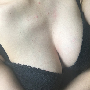 昆山百達(dá)麗醫(yī)療美容門(mén)診部醫(yī)生周嬡做自體脂肪隆胸怎么樣？附案例效果對(duì)比圖