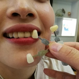 上?？仆呖谇会t(yī)院醫(yī)生鄧建儒做牙齒冷光美白怎么樣？附案例效果對比圖