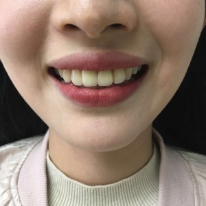 上?？仆呖谇会t(yī)院醫(yī)生鄧建儒做牙齒冷光美白怎么樣？附案例效果對比圖