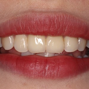 上海科瓦口腔醫(yī)院醫(yī)生鄧建儒做牙齒冷光美白怎么樣？附案例效果對比圖