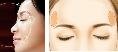 珠海仁愛整形豐太陽穴