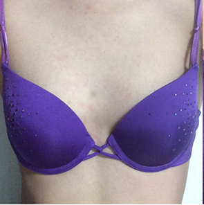 昆山百達(dá)麗醫(yī)療美容門(mén)診部醫(yī)生周嬡做自體脂肪隆胸怎么樣？附案例效果對(duì)比圖