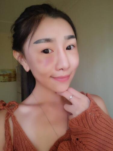 貴陽泰康樂醫(yī)院整形美容科醫(yī)生陳璐做自體脂肪全臉填充效果怎么樣？