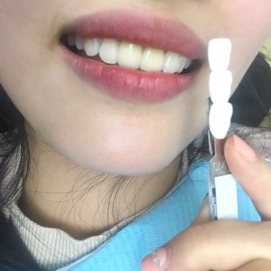 上海科瓦口腔醫(yī)院醫(yī)生鄧建儒做牙齒冷光美白怎么樣？附案例效果對比圖