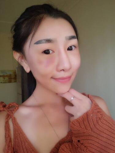 貴陽泰康樂醫(yī)院整形美容科醫(yī)生陳璐做自體脂肪全臉填充效果怎么樣？