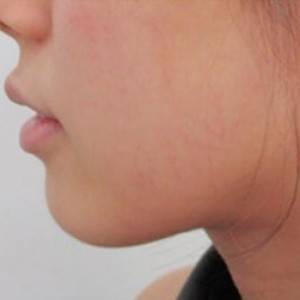 蚌埠韓美美萊整形醫(yī)院醫(yī)生張濤做玻尿酸墊下巴怎么樣？來看案例效果圖