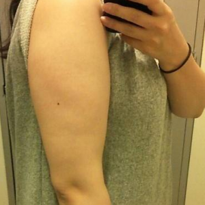 長(zhǎng)沙柒和醫(yī)療整形醫(yī)生鐘滔做手臂吸脂怎么樣？附案例效果對(duì)比圖