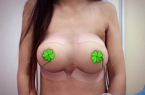 海南伊佳醫(yī)療美容醫(yī)院醫(yī)生涂陽君做假體隆胸怎么樣？附案例效果對比圖