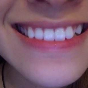 北京美年口腔醫(yī)院醫(yī)生劉海濤做牙齒冷光美白怎么樣？附案例效果對比圖