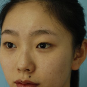 鄭州安格潤整形醫(yī)生楊曉紅做雙眼皮手術(shù)怎么樣？附案例效果圖