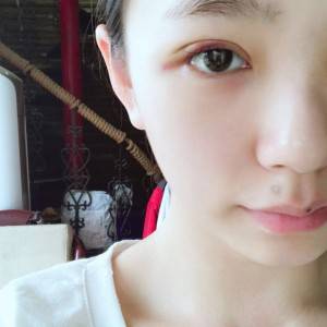 鄭州安格潤整形醫(yī)生楊曉紅做雙眼皮手術(shù)怎么樣？附案例效果圖