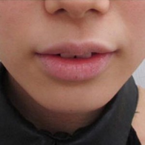 蚌埠韓美美萊整形醫(yī)院醫(yī)生張濤做玻尿酸墊下巴怎么樣？來看案例效果圖