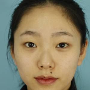 鄭州安格潤(rùn)整形醫(yī)生楊曉紅做雙眼皮手術(shù)怎么樣？附案例效果圖