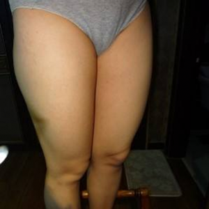 長沙真愛整形美容醫(yī)院醫(yī)生陳詠玲做大腿吸脂效果怎么樣？