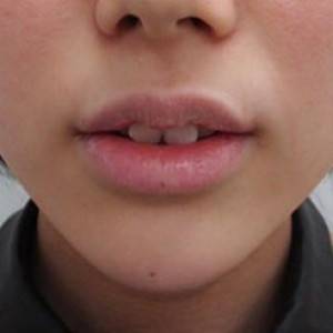 蚌埠韓美美萊整形醫(yī)院醫(yī)生張濤做玻尿酸墊下巴怎么樣？來看案例效果圖