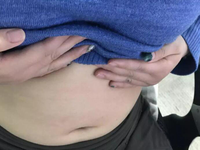 廣州尚美善造美容醫(yī)院醫(yī)生邵方做水動(dòng)力吸脂怎么樣？附案例效果圖