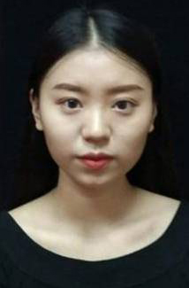 長(zhǎng)沙星雅醫(yī)療美容醫(yī)院醫(yī)生陳煥武做埋線提升怎么樣？