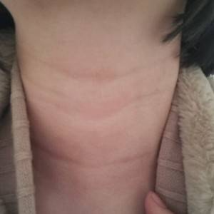 昭通愛麗諾整形醫(yī)生陳志江做嗨體去頸紋怎么樣？附案例效果圖