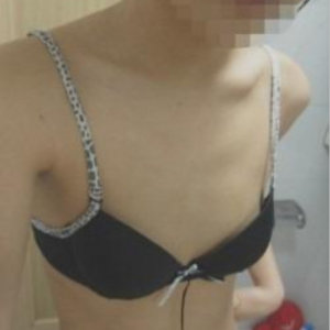 三亞圣迪亞整形美容醫(yī)院醫(yī)生韓超做假體隆胸怎么樣？附案例效果對比圖