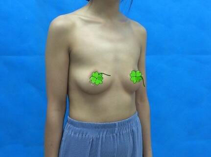 海南伊佳醫(yī)療美容醫(yī)院醫(yī)生涂陽君做假體隆胸怎么樣？附案例效果對比圖